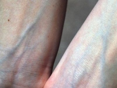 چرا با اینکه خون قرمز است، رگ‌ها آبی دیده می‌شوند؟