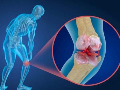 چگونه خطر پوکی استخوان را در دوران کرونا کاهش دهیم؟