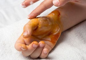 پیشگیری از بروز سوختگی در ایام نوروز