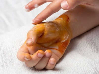 پیشگیری از بروز سوختگی در ایام نوروز