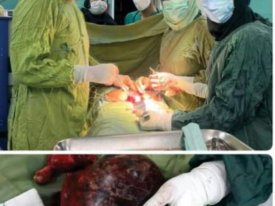 خروج توده ۲ کیلوگرمی از شکم یک بیمار ۶۷ ساله نی ریزی