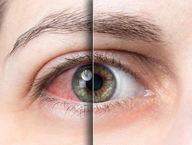۵۰ درصد مراجعين به متخصصين چشم در جهرم، از خشكي چشم رنج مي برند