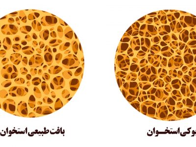 پوکی استخوان، یک اپیدمی خاموش