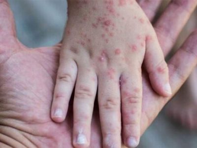 وزیر بهداشت: سرخک و سرخجه در ایران ریشه‌کن شد