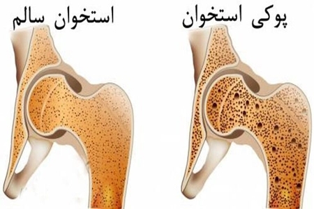 پوکی استخوان قابل درمان است